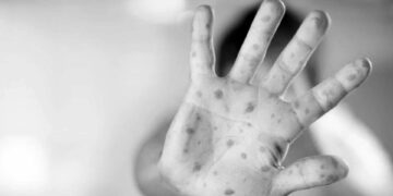 DSÖ maymun çiçeği salgınını ‘küresel acil durum’ ilan etti